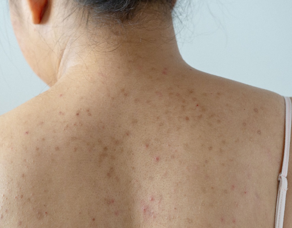 Acne Facial in Los Angeles!