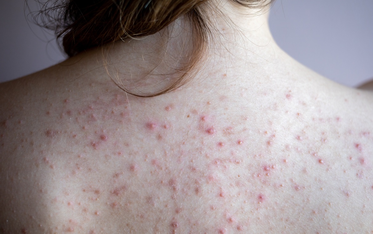 Clear Up with Our Acne Facial in Los Angeles!